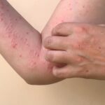 Horse Plague Hits Saunas? Close-up of a persons arm with red spots and a hand scratching the skin