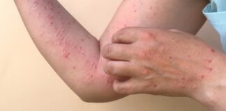 Close-up of a persons arm with red spots and a hand scratching the skin