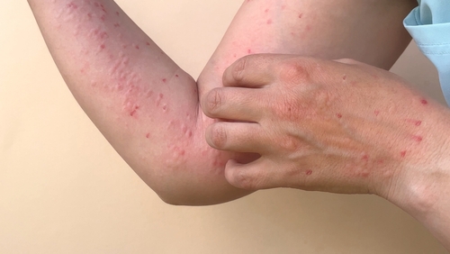 Close-up of a persons arm with red spots and a hand scratching the skin