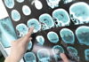A healthcare professional pointing at brain scan images showing signs of a stroke