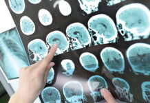 Unprecedented Win Against Deadly Tumor A healthcare professional pointing at brain scan images showing signs of a stroke